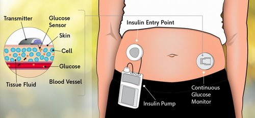 A continuous glucose monitor measures the level of insulin in the interstitial fluid image photo picture